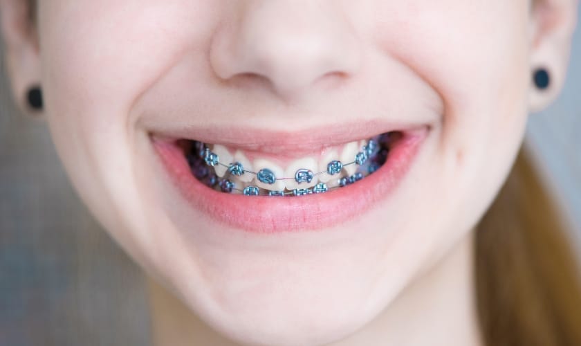 Right Braces: Understanding Different Types for Your Smile